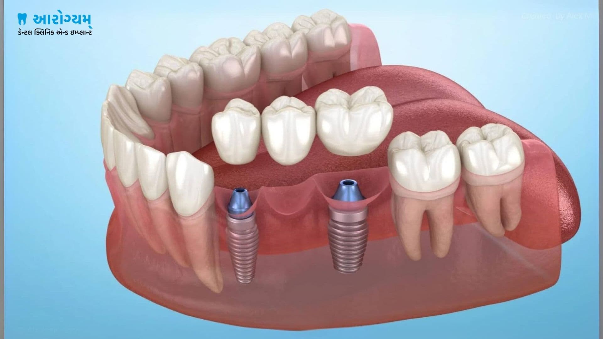 Pterygoid implant cost in Rajkot