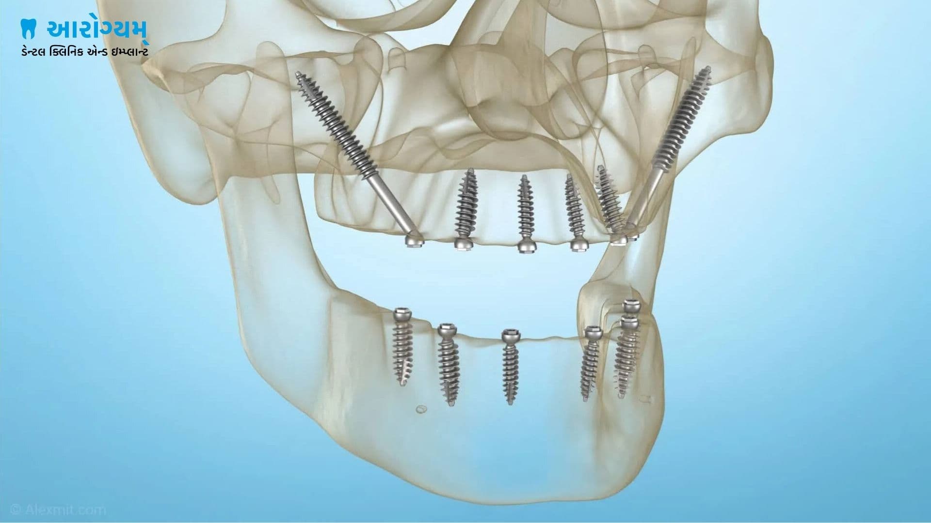 Full mouth pterygoid implant support in Rajkot
