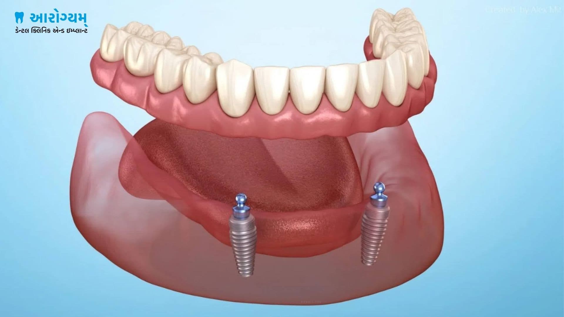 Snap on denture implants at Junagadh