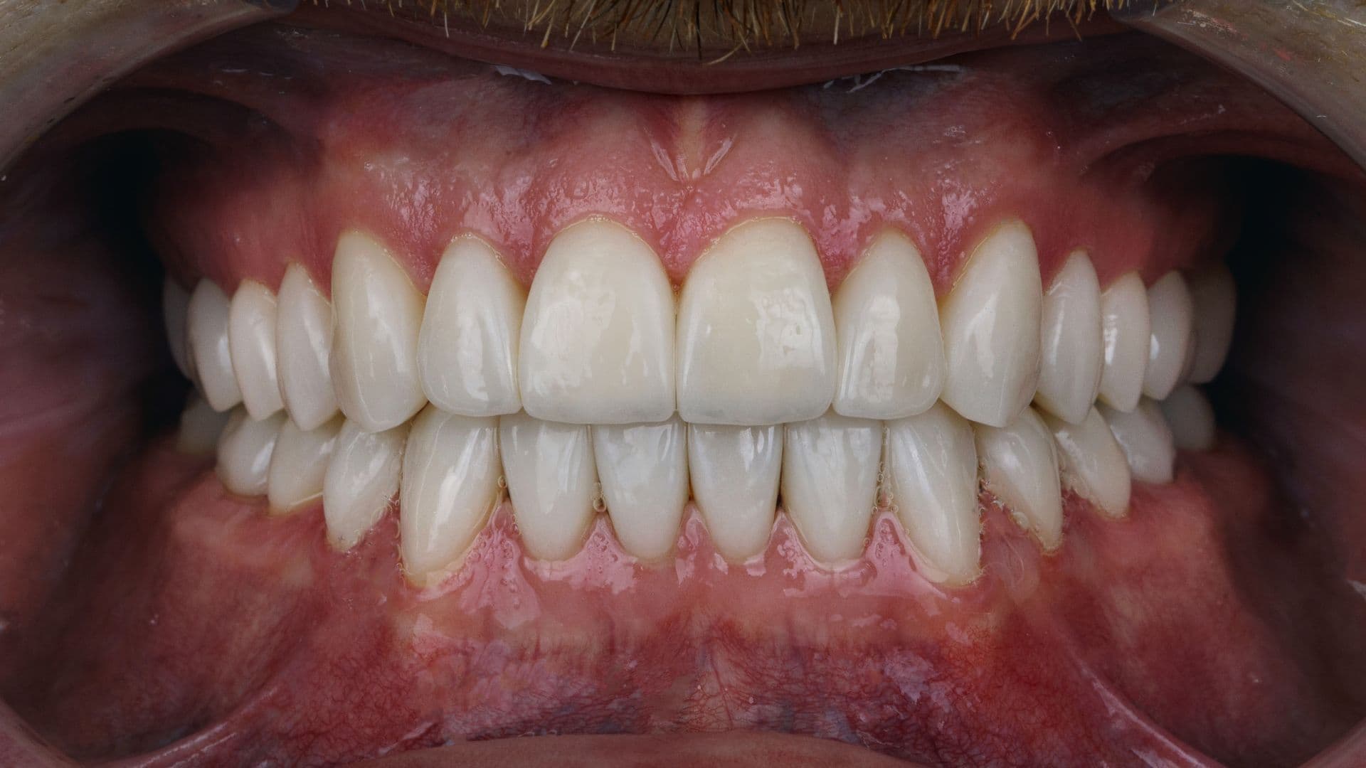 Rajkot's Leading Specialist for Full Mouth Rehabilitation.