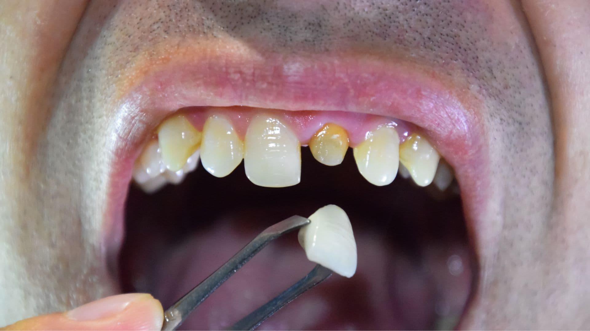 Full Mouth Rehabilitation Cost in Rajkot