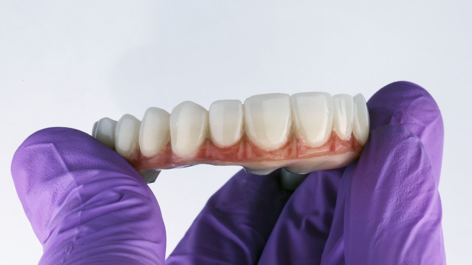 Affordable Full Mouth Rehabilitation in Rajkot for a Beautiful Smile