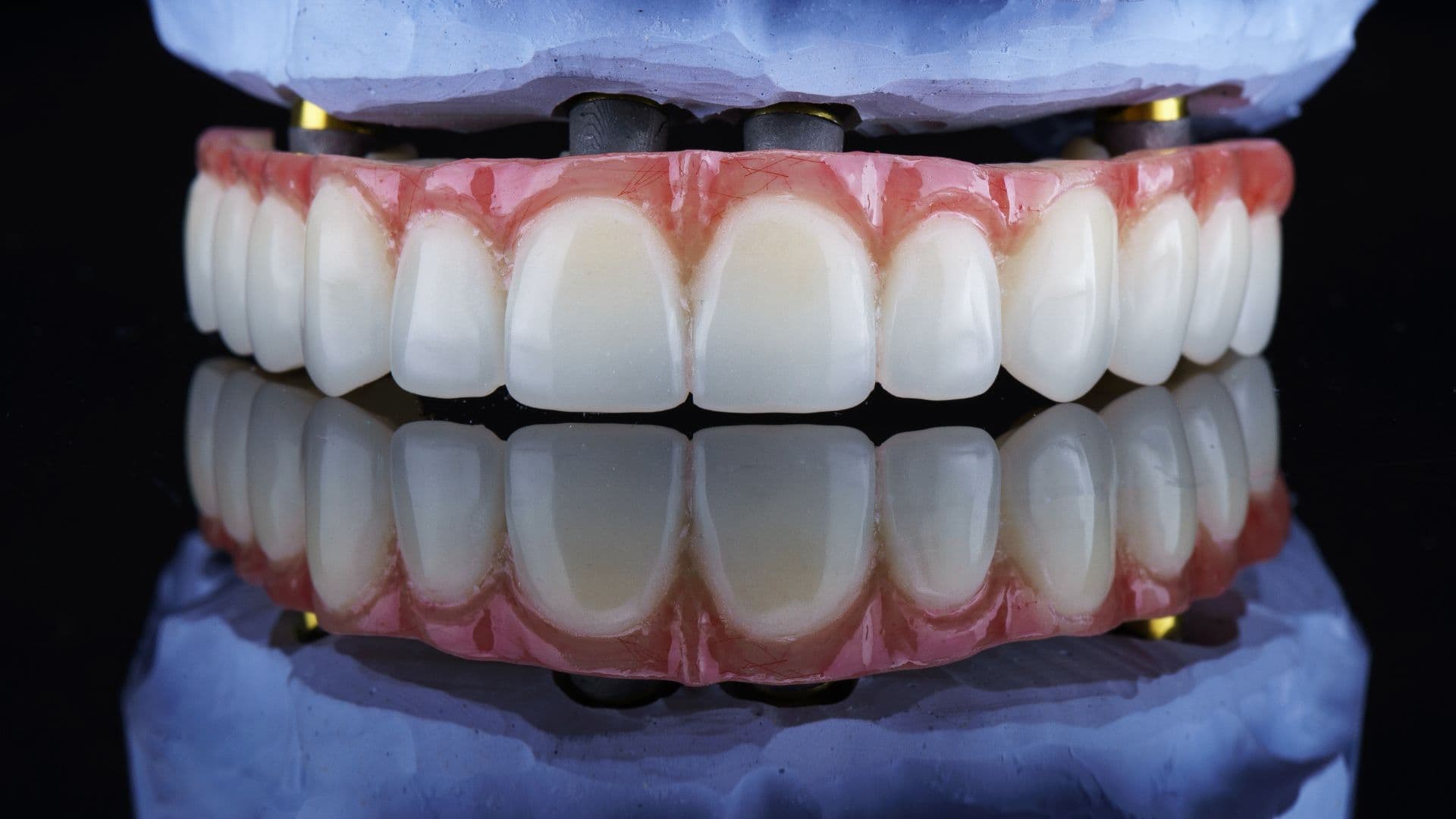 Full Mouth Rehabilitation in Rajkot | Top Rated