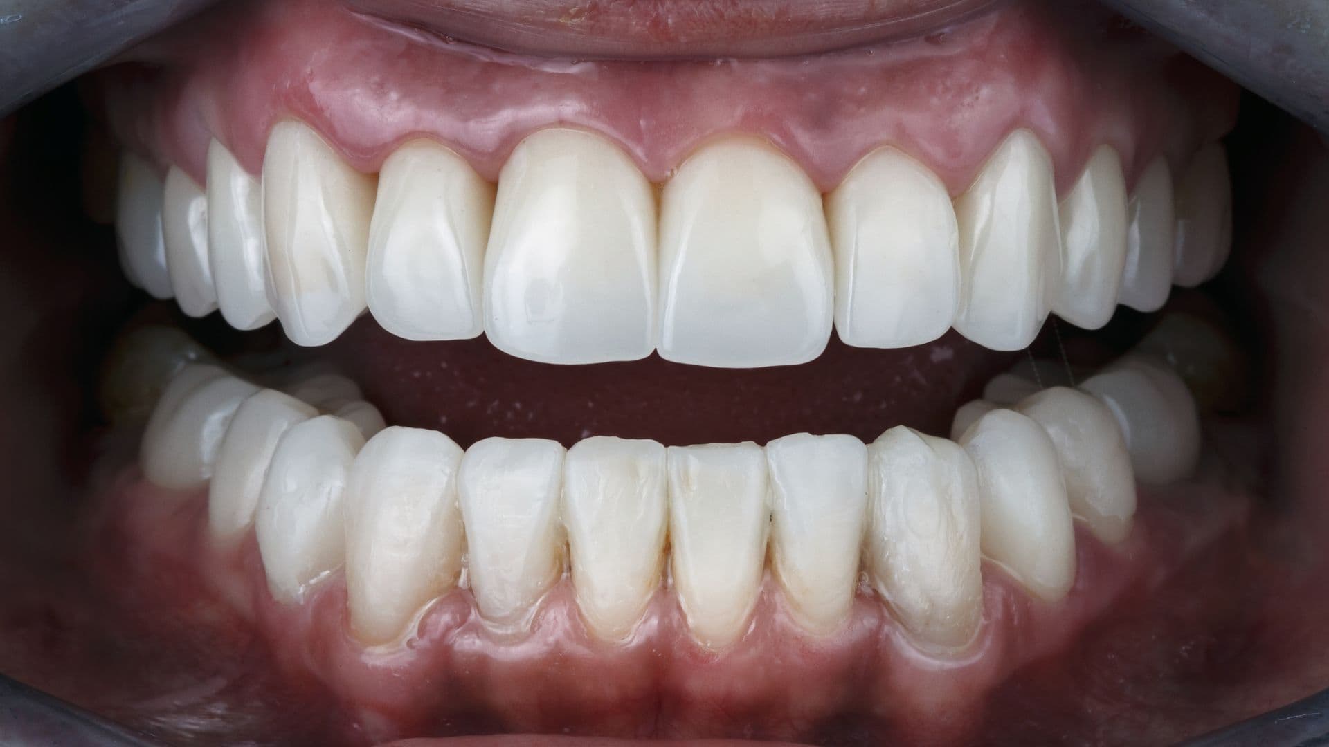 Rajkot's Leading Prosthodontist for Full Mouth Rehabilitation.