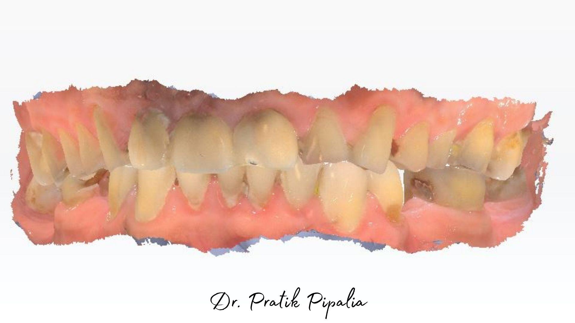 Jayeshbhai S before full mouth rehabilitation at Aarogyam Dental Clinic Rajkot