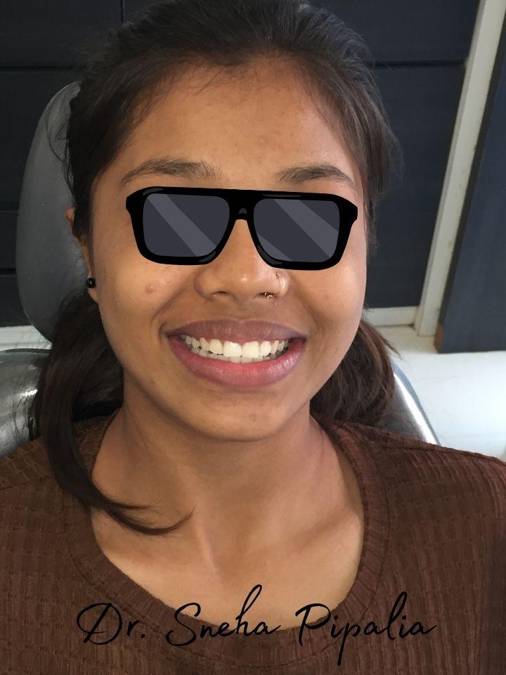 Nirali H from Rajkot after braces at Aarogyam Dental Clinic, Mavdi, Rajkot, Gujarat