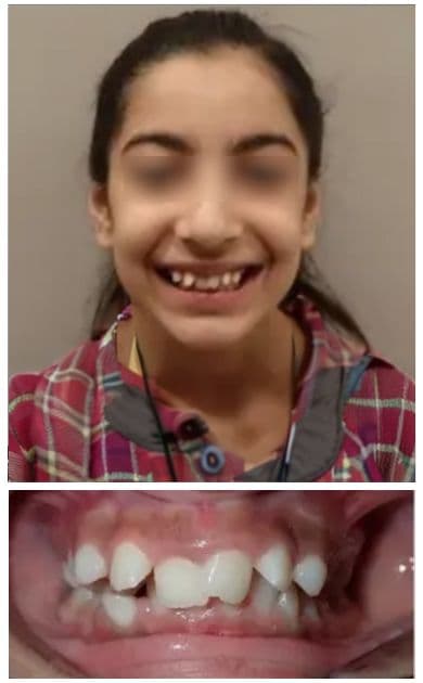 Before smile treatment — facial view